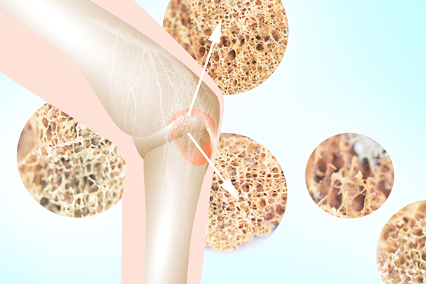 Multiple Myeloma